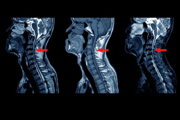 MRI Scan of Cervical Spine and Neck