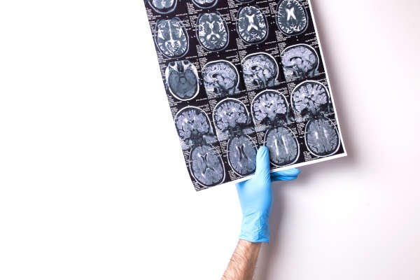 A Radiologist holding the head CT image