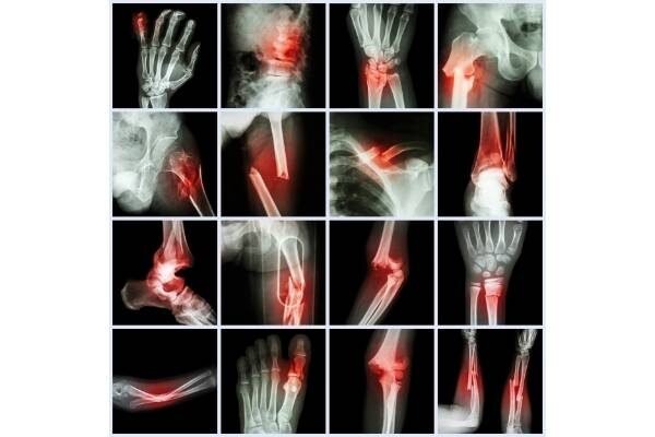 bone fracture assessment