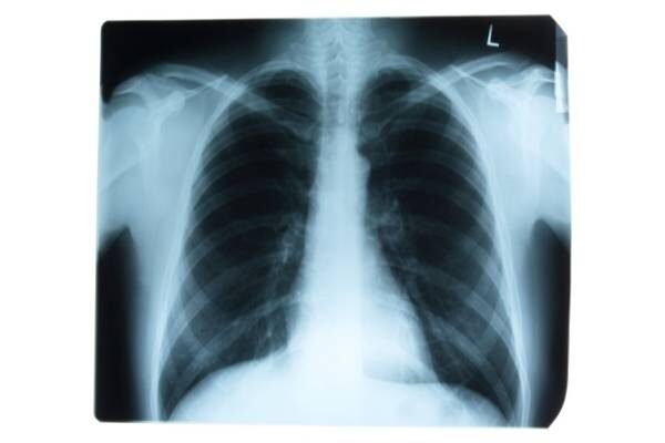 chest x ray interpretation