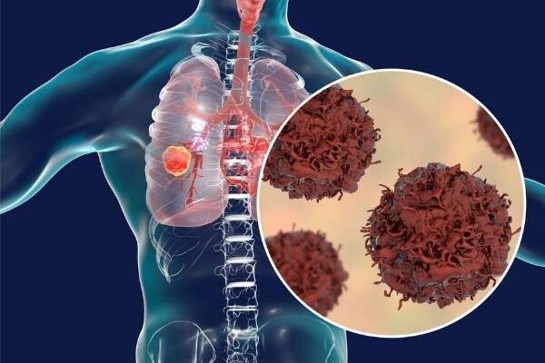 lung cancer screening