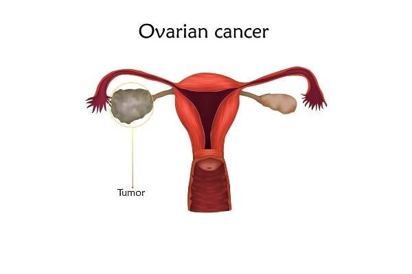 ovarian cancer diagnosis