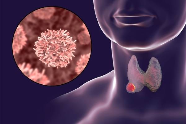 thyroid cancer detection